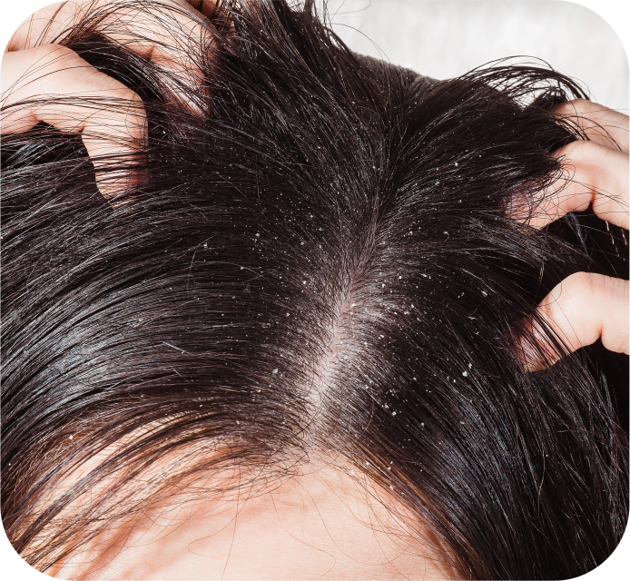 Scalp Disorders